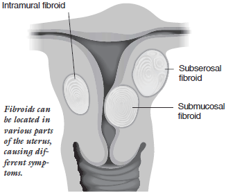 Fibromes uterins : symptômes et traitement - CAIR