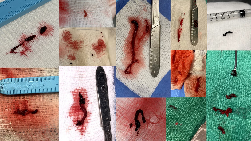 Collage of clot retrieved by Kelowna EVT team